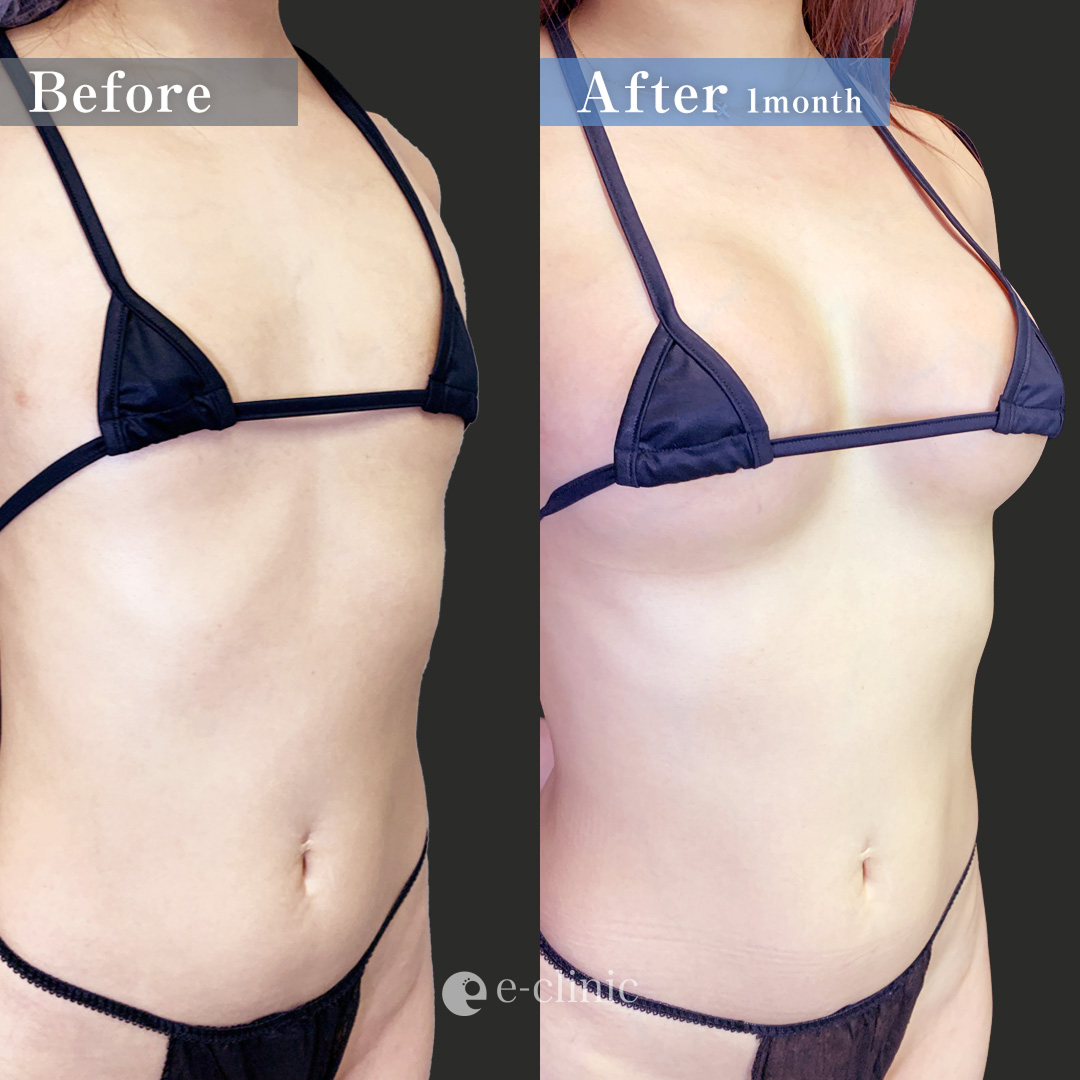 ハイブリッド豊胸（名医の田中里佳医師が執刀）