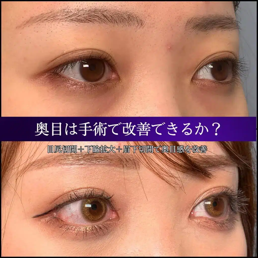 目尻切開 眉下切開