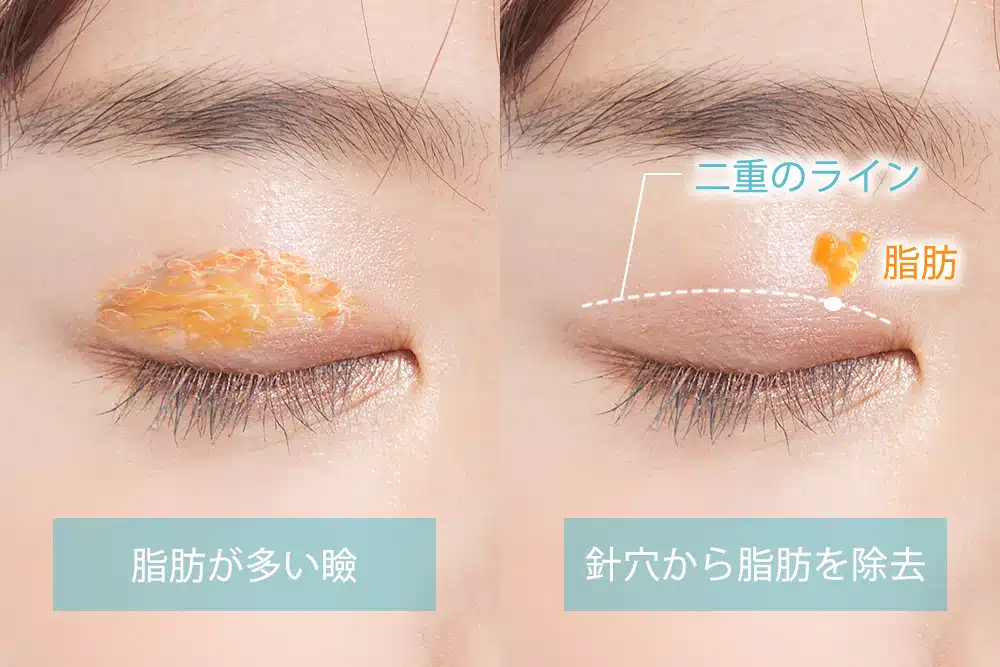 まぶたの脂肪取り