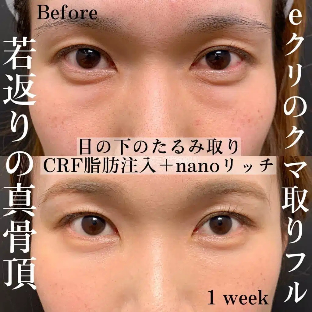 たるみ取り 脂肪注入