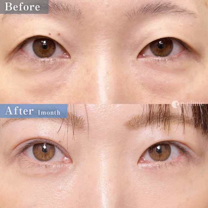 裏ハムラ＋二重埋没法_自然癒着法（名医の劉奕陽医師が執刀）