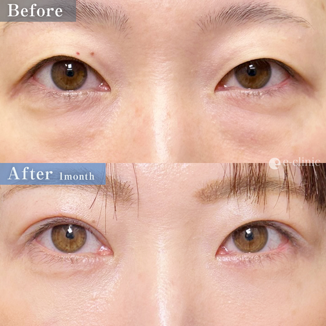 裏ハムラ＋二重埋没法_自然癒着法（名医の劉奕陽医師が執刀）