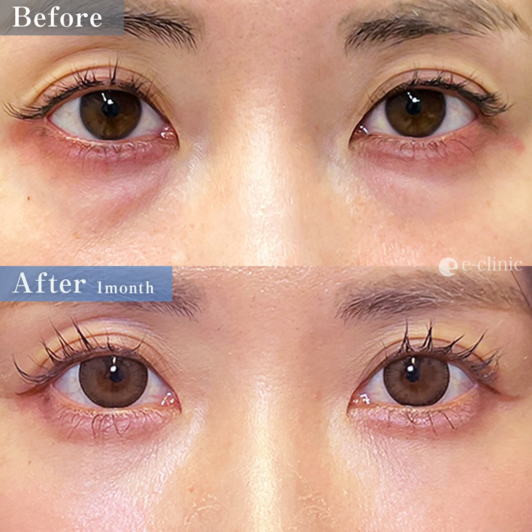 クマ取り_経血膜脱脂＋脂肪注入（名医の劉奕陽医師が執刀）