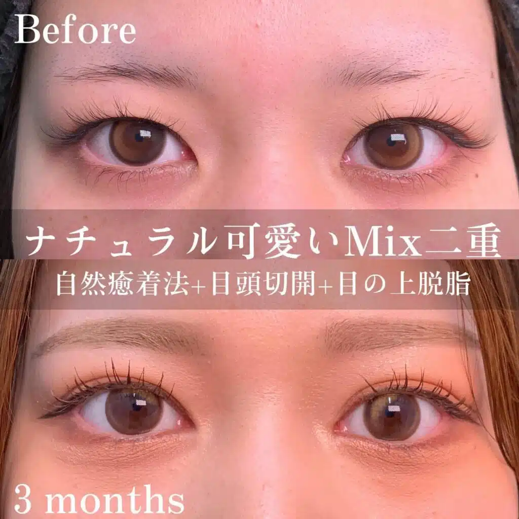 自然癒着法 目頭切開 脱脂