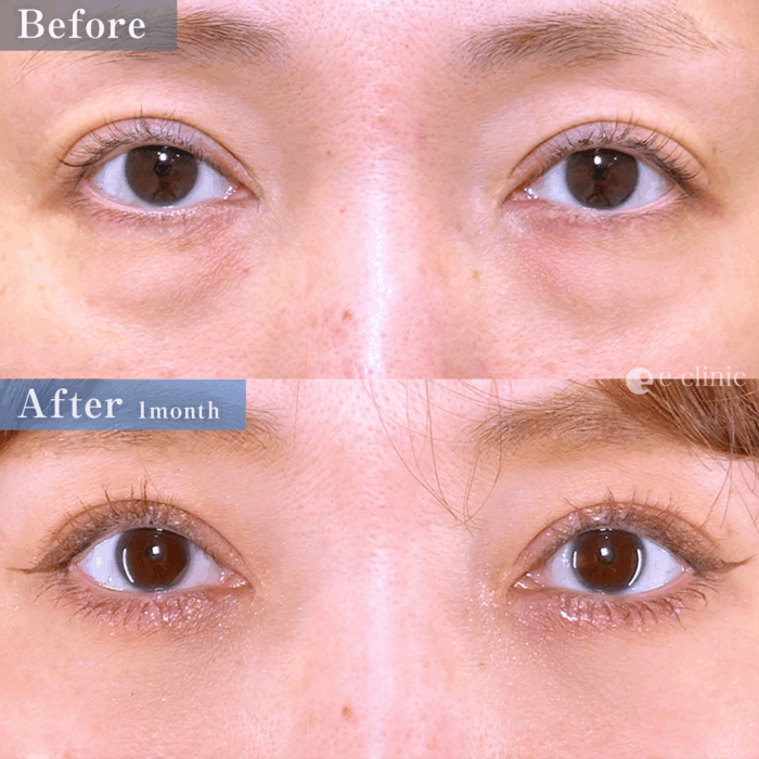 クマ取り_裏ハムラ法＋ナノリッチ（名医の劉奕陽医師が執刀）（51）