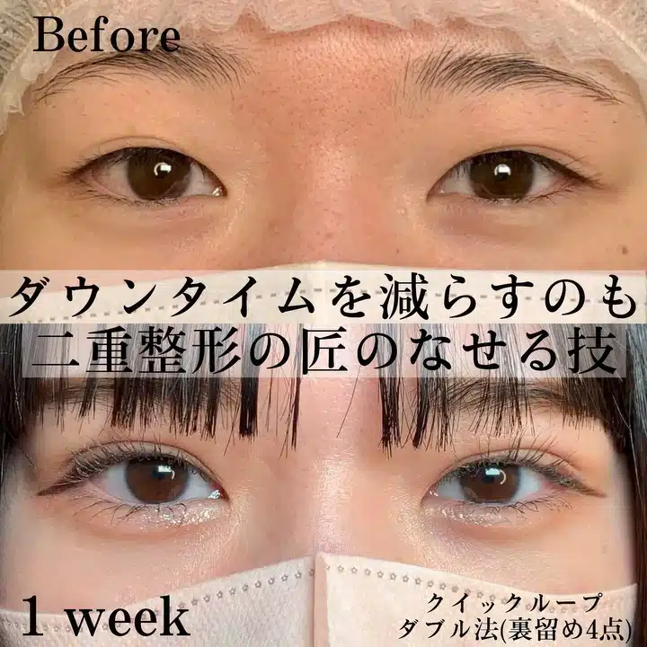 二重 クイックループダブル法