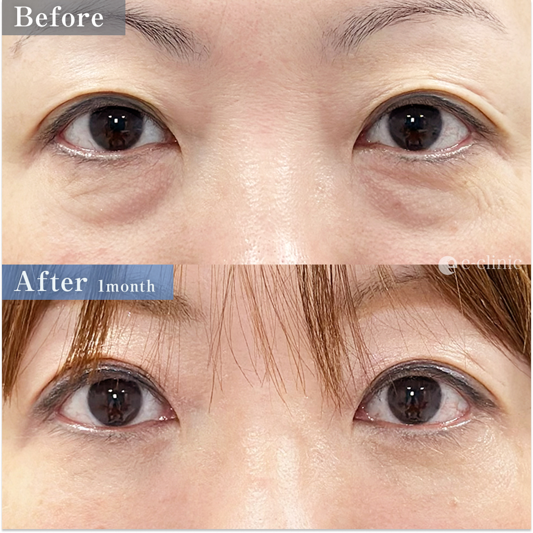 クマ取り_裏ハムラ＋ナノリッチ脂肪注入＋内固定オプション（名医の服部健人医師が執刀）