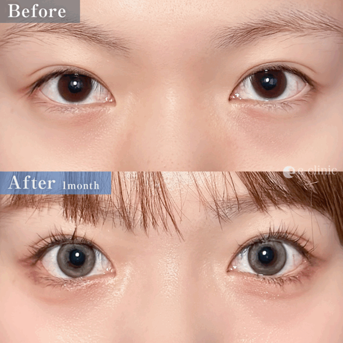 目尻切開+たれ目形成(皮膚結膜)(名医の服部健人医師が執刀)