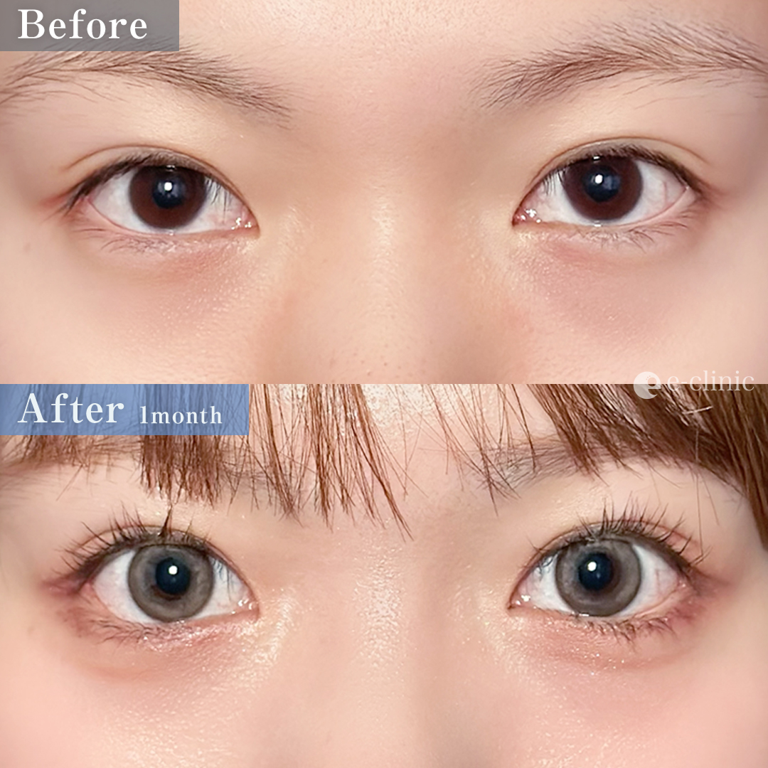 目尻切開＋たれ目形成（皮膚結膜）（名医の服部健人医師が執刀）（59）