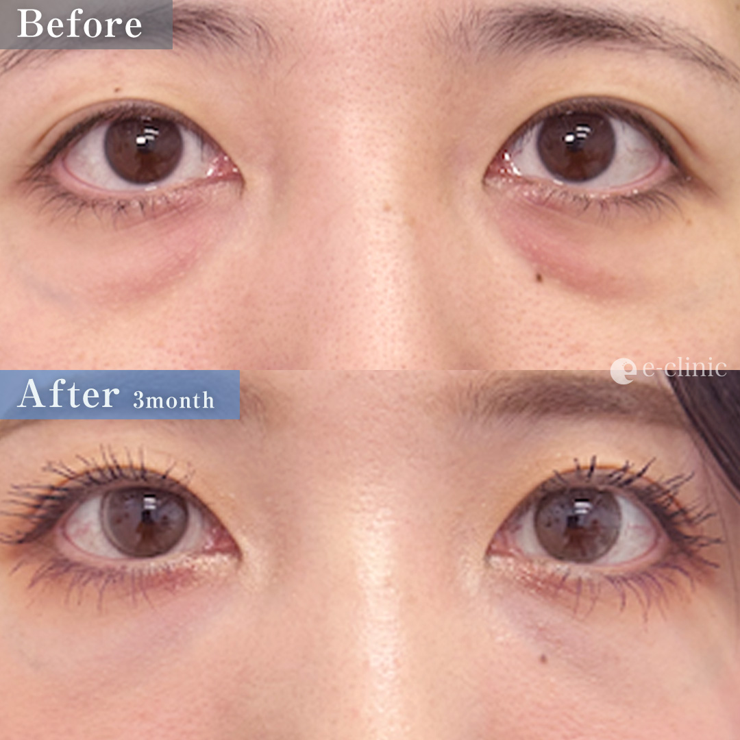 クマ取り_裏ハムラ＋ナノリッチ脂肪注入（名医の伊藤渉医師が執刀）