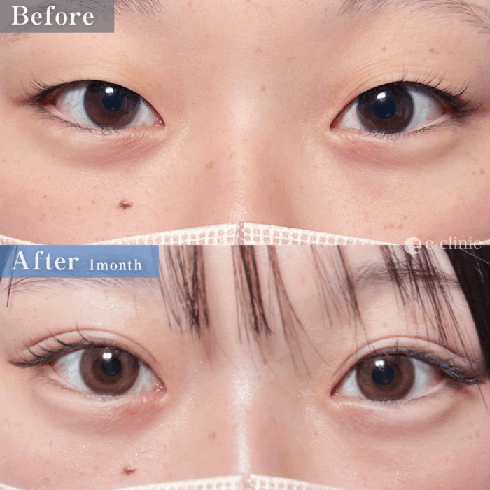 二重埋没法_自然癒着法（名医の伊藤渉医師が執刀）