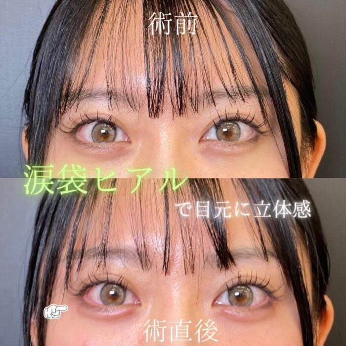 涙袋のヒアルロン酸