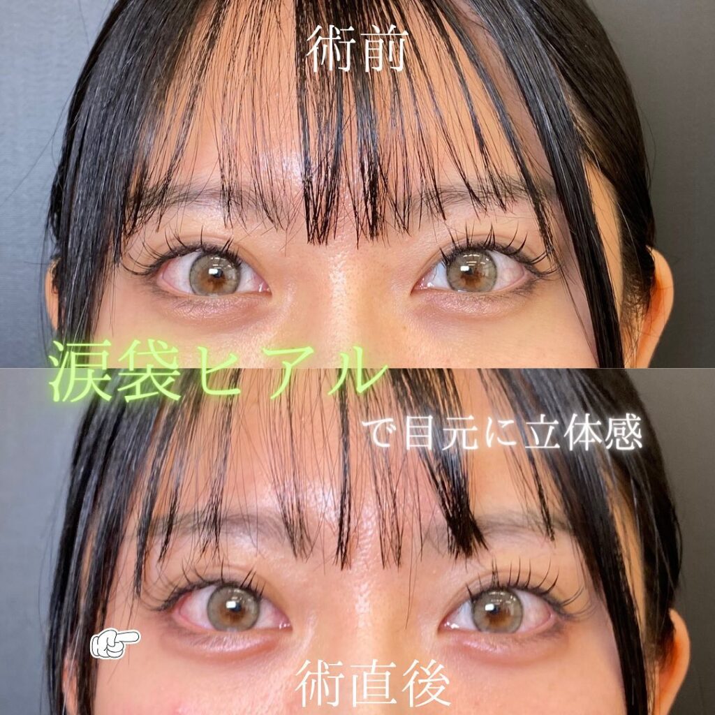 涙袋のヒアルロン酸