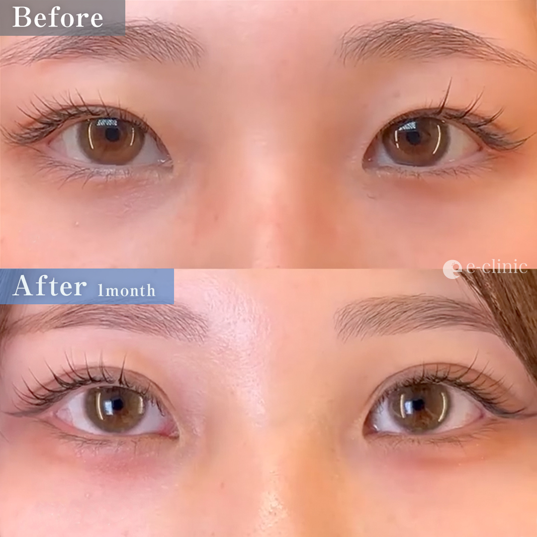 二重埋没法_クイックループダブル4点裏留め（名医の島田良浩医師が執刀）