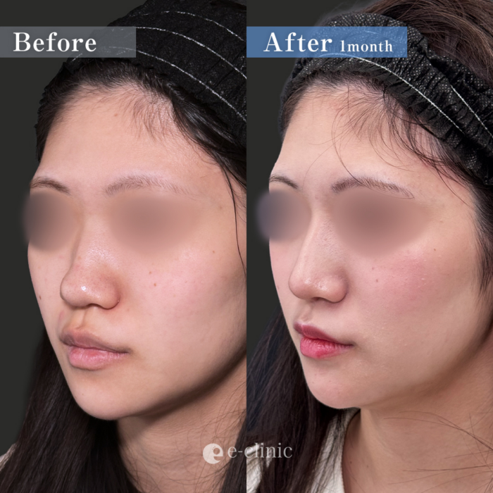 鼻フル整形（名医の伊藤医師が執刀）・鼻尖形成3D法、
・耳介軟骨移植
・鼻柱下降
・鼻プロテーゼ