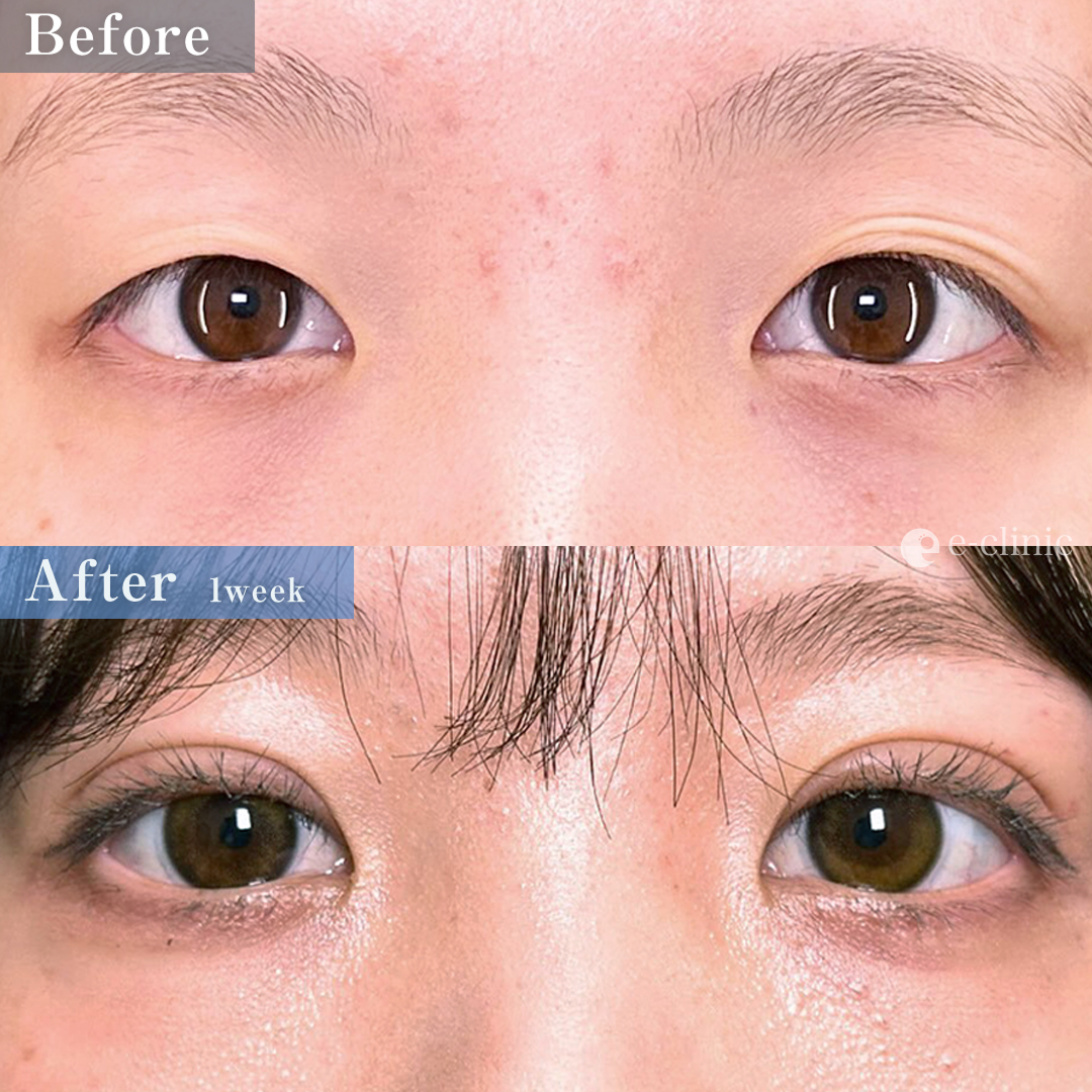 二重埋没法_自然癒着法（名医の相原隆充医師が執刀）