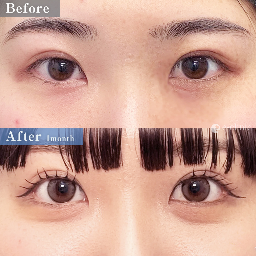 タレ目形成（結膜法）＋目尻切開＋経結膜脱脂（名医の八木良太医師が執刀）