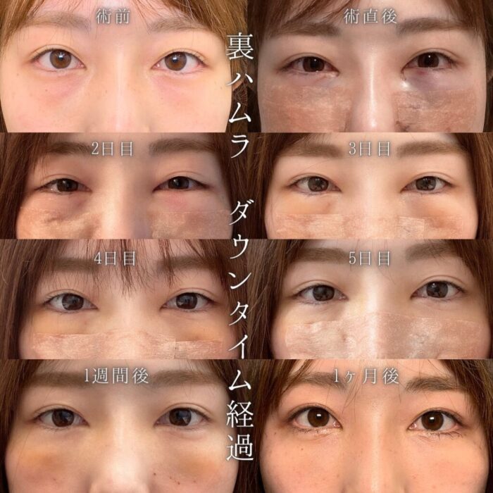 クマ取り ダウンタイム経過