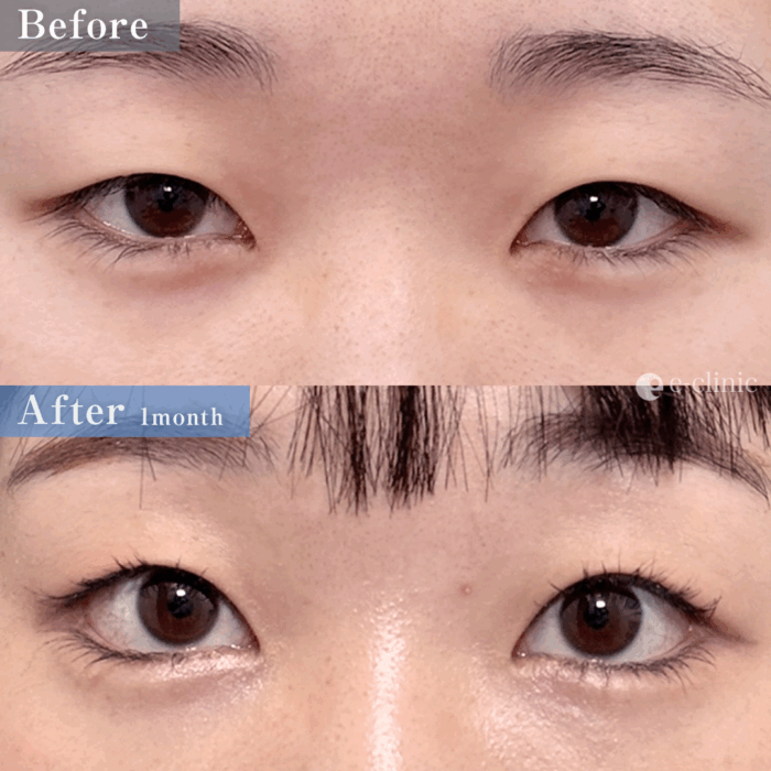 タレ目形成（結膜法）＋目尻切開（名医の八木良太医師が執刀）