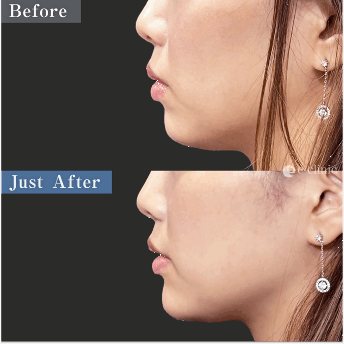 顎ヒアルロン酸1cc（名医の八木良太医師が執刀）