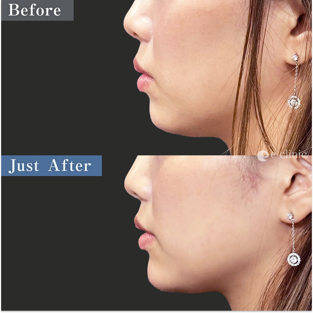 顎ヒアルロン酸1cc（名医の八木良太医師が執刀）