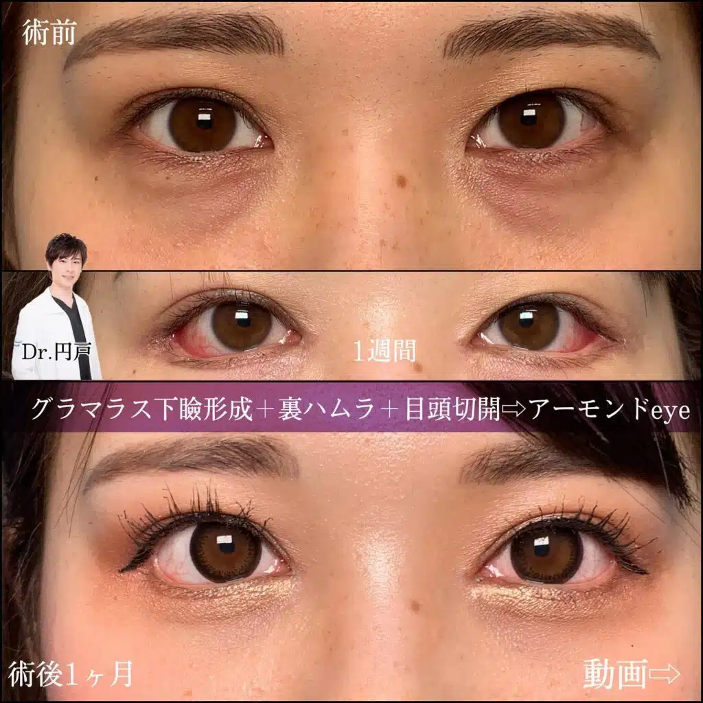 裏ハムラ 目頭切開