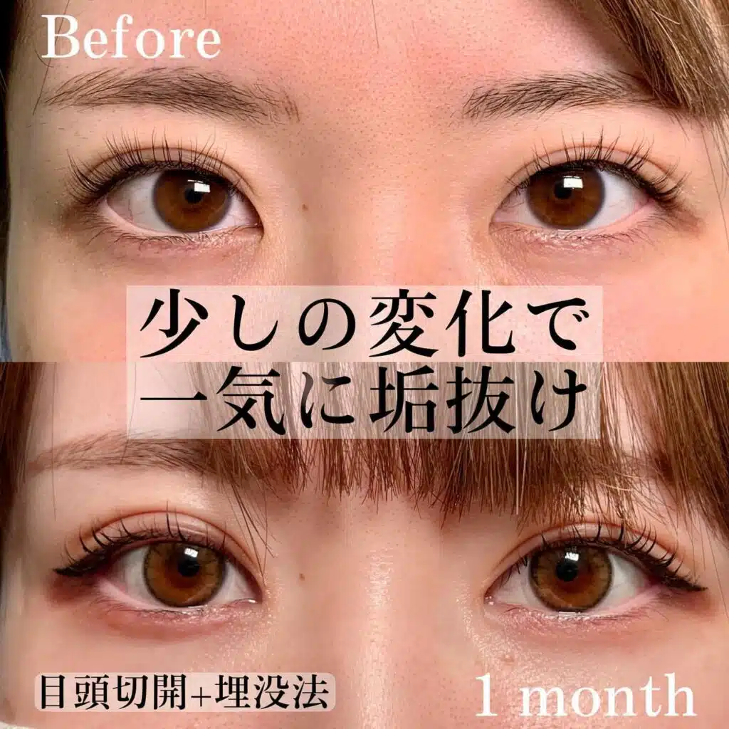 目頭切開 埋没法