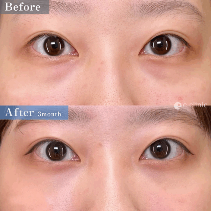 クマ取り_裏ハムラ法（名医の島田良浩医師が執刀）