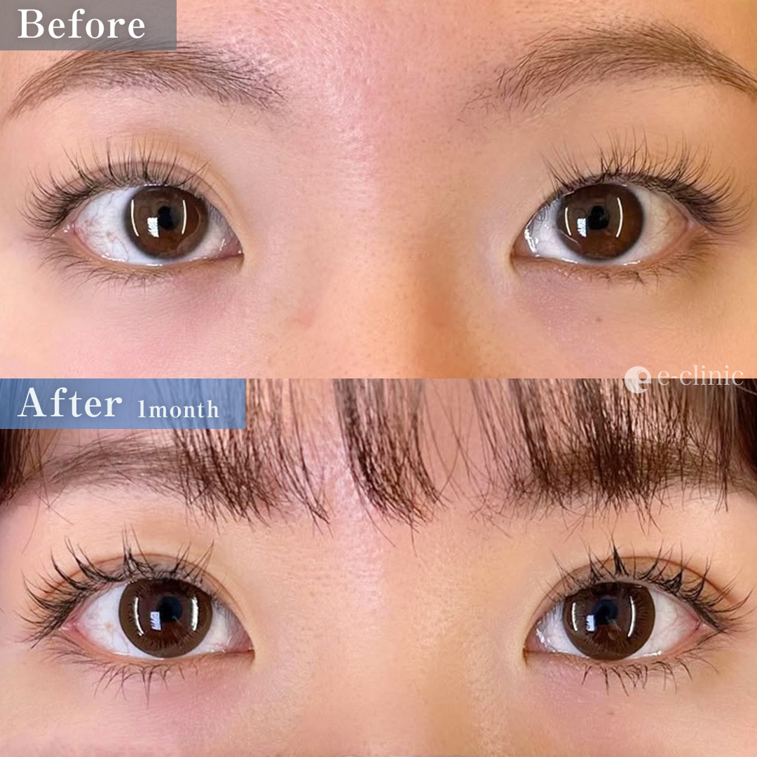 二重埋没法_クイックループダブル4点裏留め（名医の島田良浩医師が執刀）