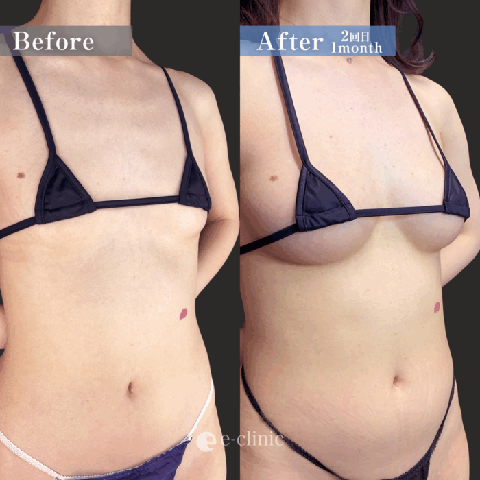 コンデンス豊胸2回（名医の田中里佳医師が執刀）