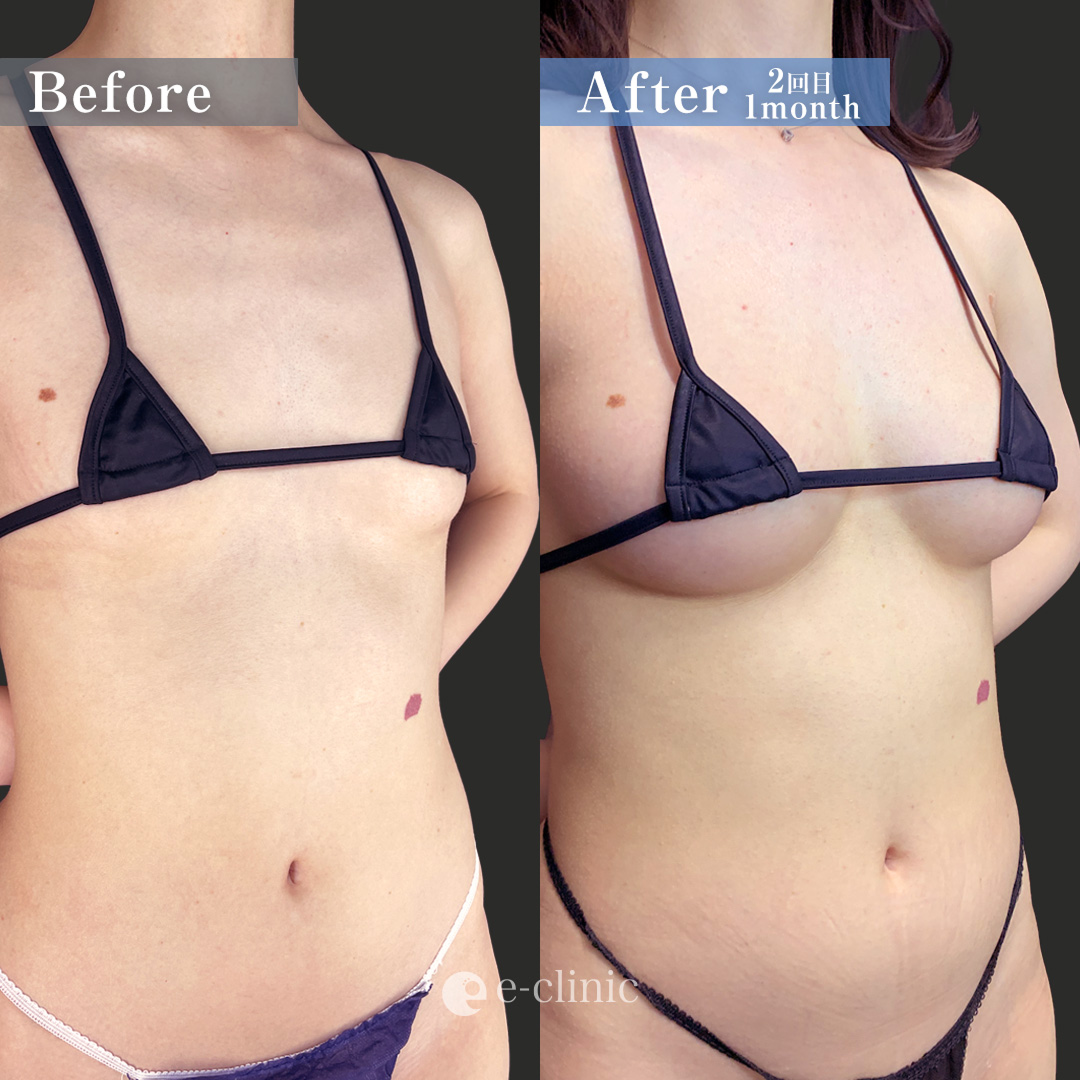 コンデンス豊胸2回（名医の田中里佳医師が執刀）