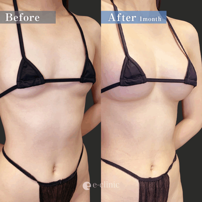 ハイブリッド豊胸（名医の田中里佳医師が執刀）