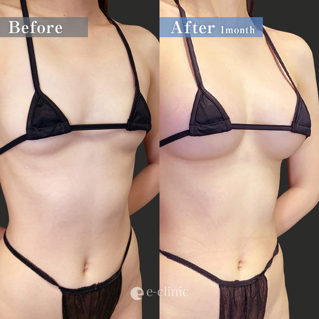 ハイブリッド豊胸（名医の田中里佳医師が執刀）