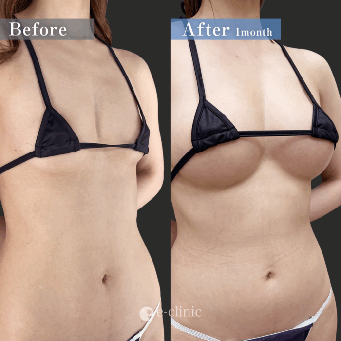 コンデンス豊胸2回（名医の田中里佳医師が執刀）