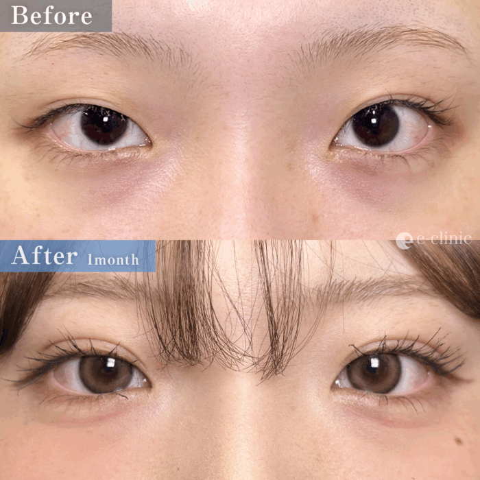 二重埋没_自然癒着法（名医の劉奕陽医師が執刀）