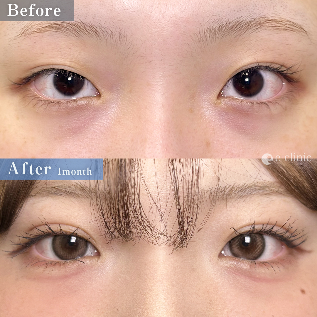 クマ取り_裏ハムラ法（名医の劉奕陽医師が執刀）