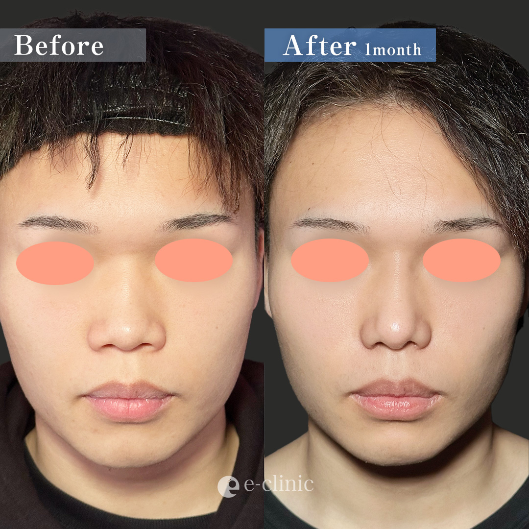 鼻尖形成3D法＋鼻尖部軟骨移植＋小鼻縮小(内外側法/引き締め縫合) ＋鼻柱下降＋プロテーゼ（名医の服部健人医師が執刀）