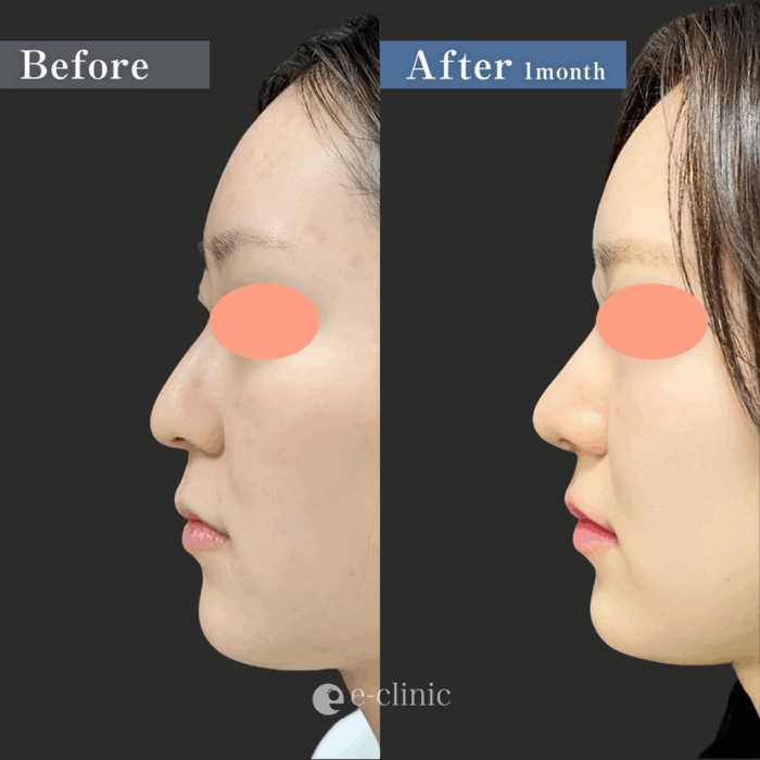 鼻尖形成3D法 ＋耳介軟骨移植（名医の服部健人医師が執刀）