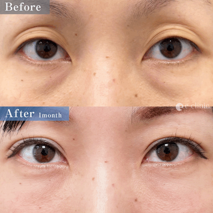 二重埋没法_自然癒着法＋裏ハムラ法（名医の伊藤渉医師が執刀）