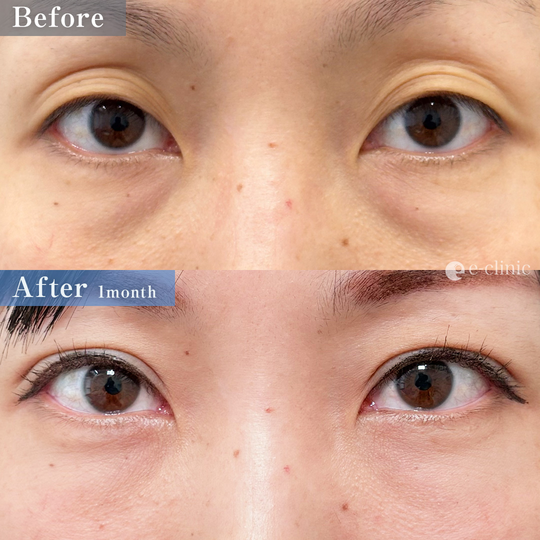 二重埋没法_自然癒着法＋裏ハムラ法（名医の伊藤渉医師が執刀）