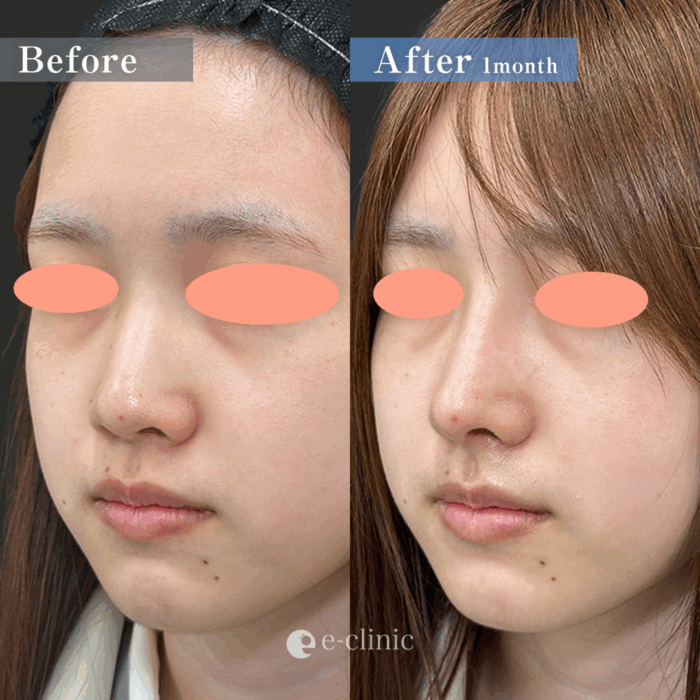 鼻中隔延長(耳介軟骨) ＋鼻尖形成3D法 ＋耳介軟骨移植 ＋鼻プロテーゼ ＋小鼻縮小(内側法)（名医の伊藤渉医師が執刀）