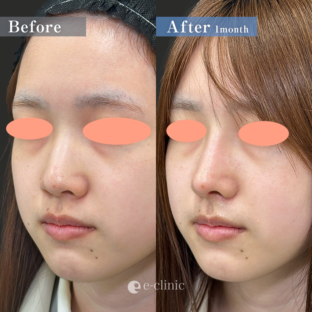 鼻中隔延長(耳介軟骨) ＋鼻尖形成3D法 ＋耳介軟骨移植 ＋鼻プロテーゼ ＋小鼻縮小(内側法)（名医の伊藤渉医師が執刀）