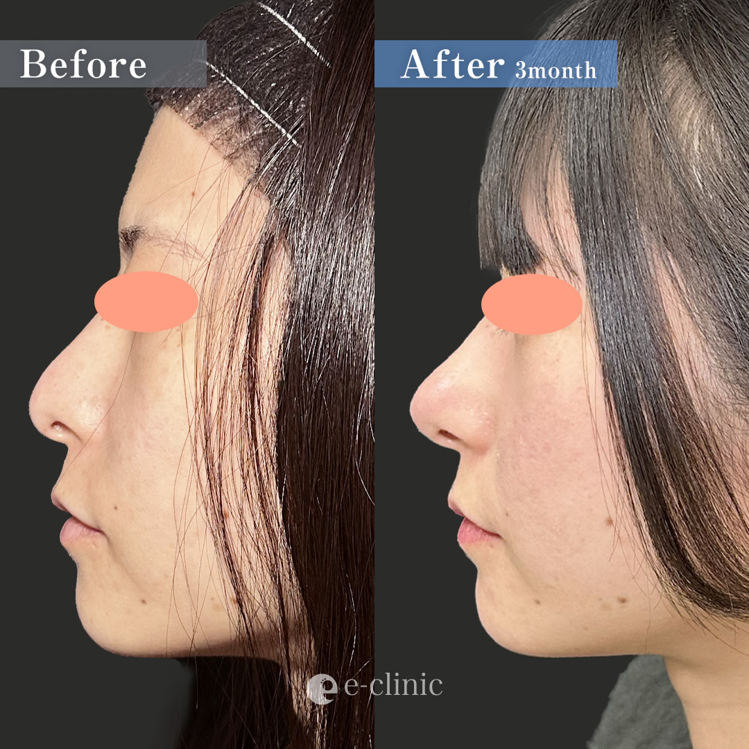 鼻尖形成クローズ法＋耳介軟骨移植（名医の伊藤渉医師が執刀）