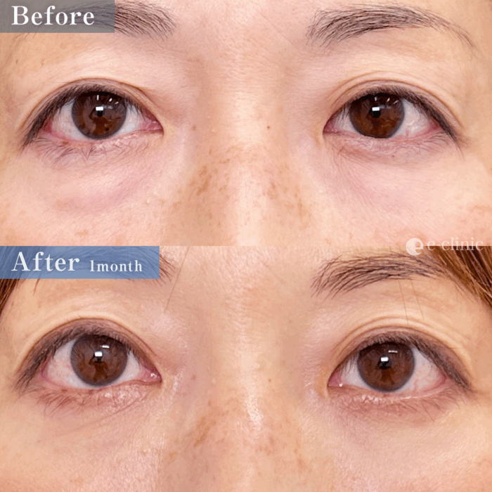 クマ取り_裏ハムラ法（名医の山本彬文医師が執刀）（89）