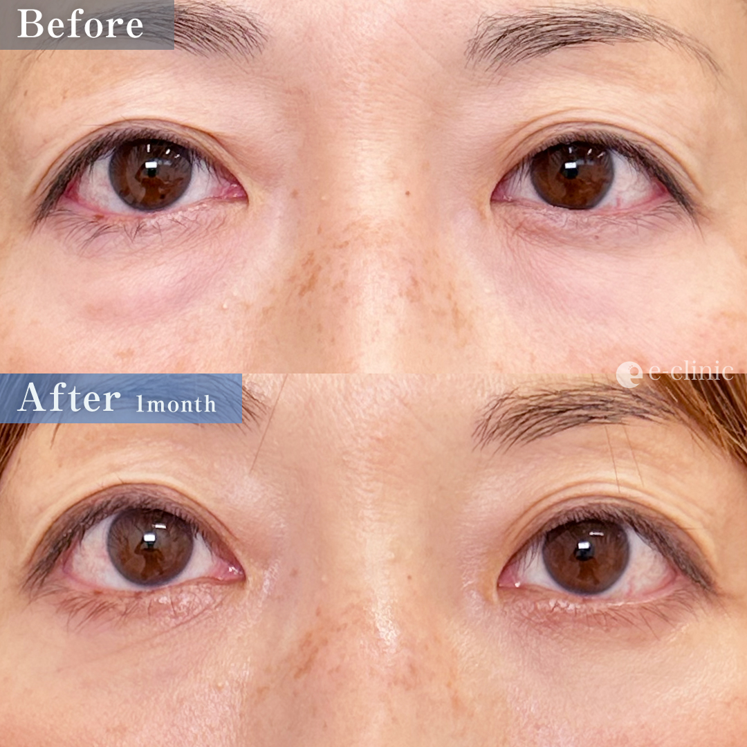 クマ取り_裏ハムラ法（名医の山本彬文医師が執刀）