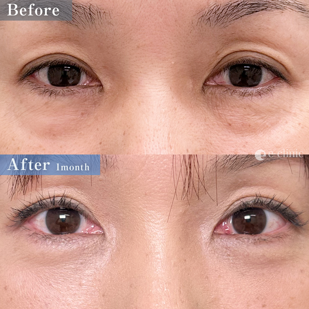 クマ取り_裏ハムラ法（名医の山本彬文医師が執刀）