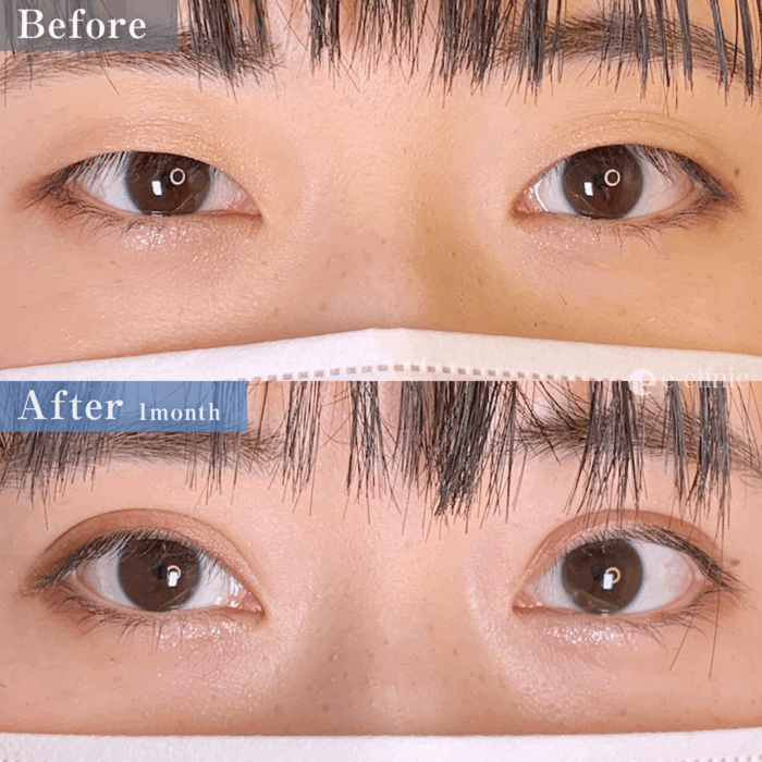 二重埋没法_特殊6点留め（名医の張田修平医師が執刀）