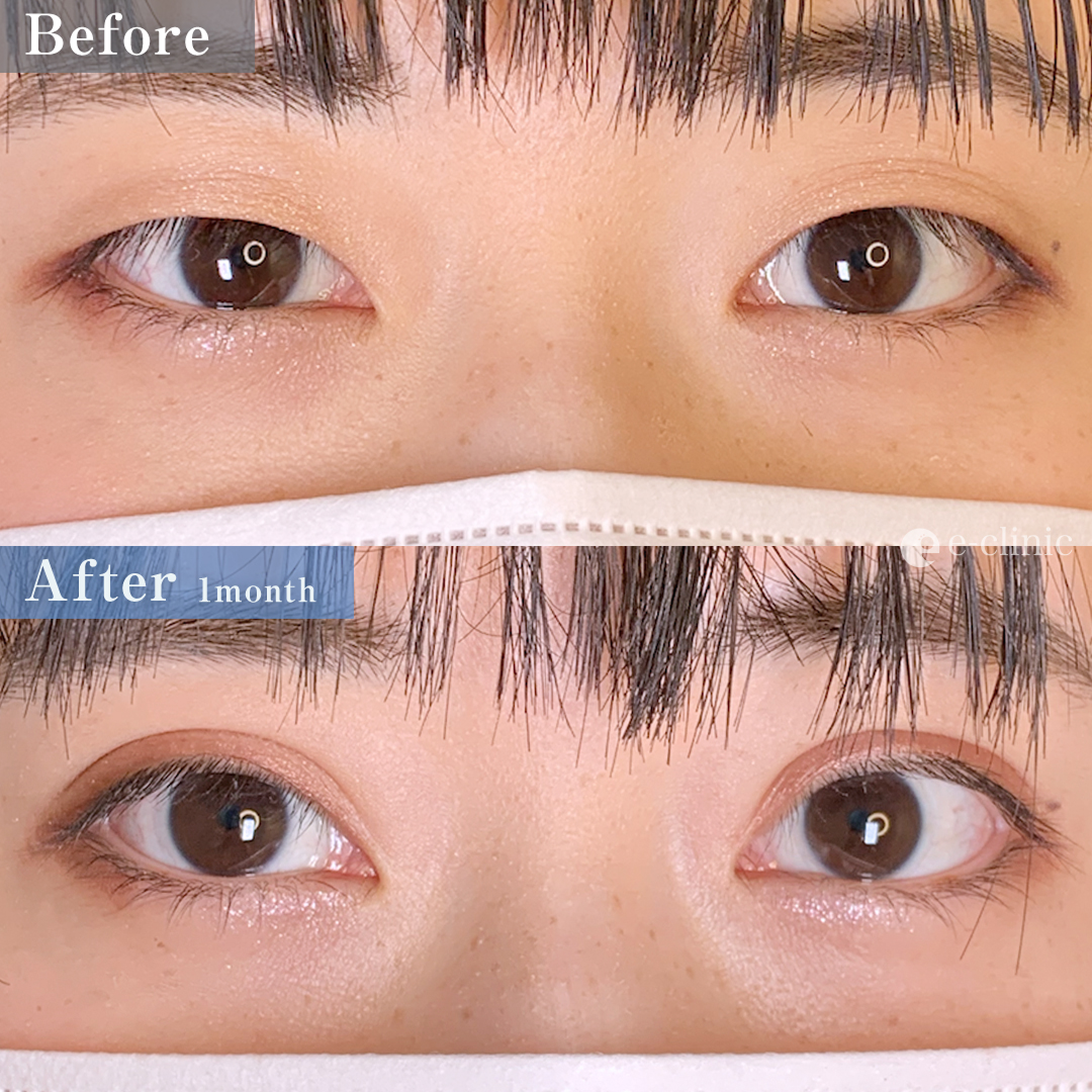 二重埋没法_特殊6点留め（名医の張田修平医師が執刀）