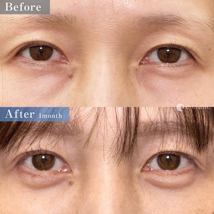 クマ取り_経血膜脱脂＋脂肪注入（名医の坂本優衣医師が執刀）