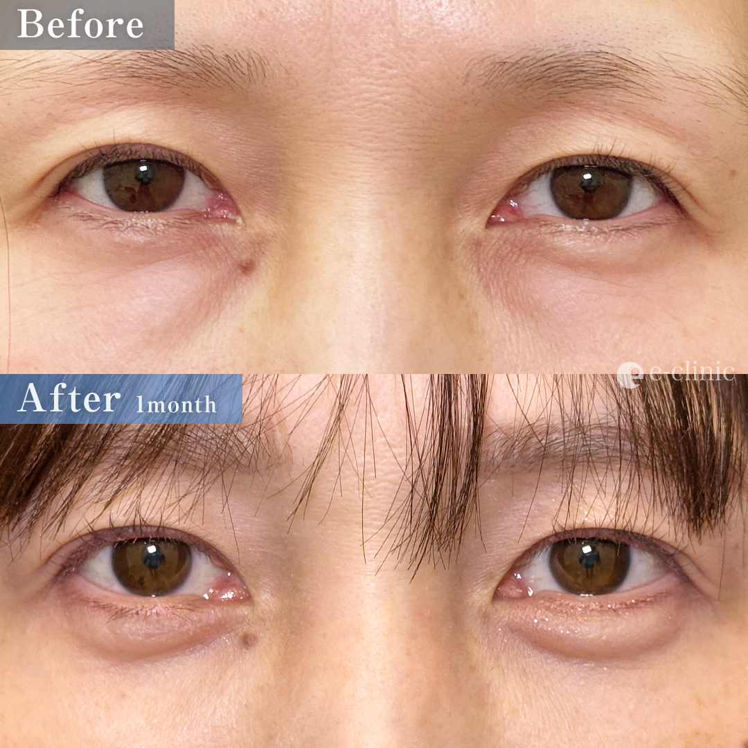 クマ取り_経血膜脱脂＋脂肪注入（名医の坂本優衣医師が執刀）